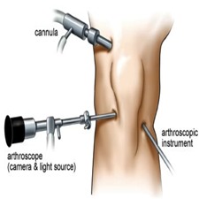 knee arthrocopy mikro